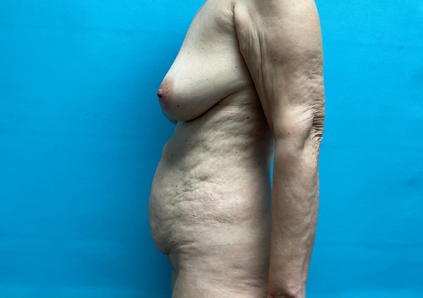 Mommy Makeover: Case 14 - Before