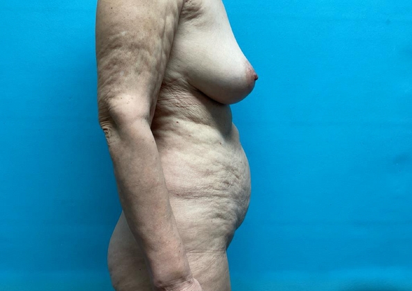 Mommy Makeover: Case 14 - Before