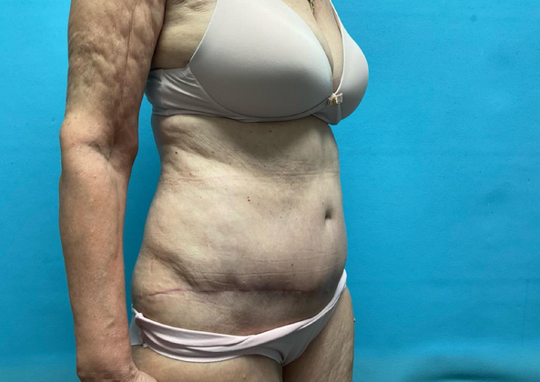 Mommy Makeover: Case 14 - After