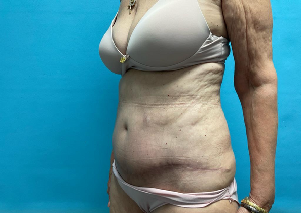 Mommy Makeover: Case 14 - After