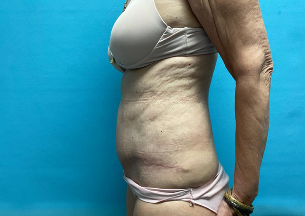 Mommy Makeover: Case 14 - After