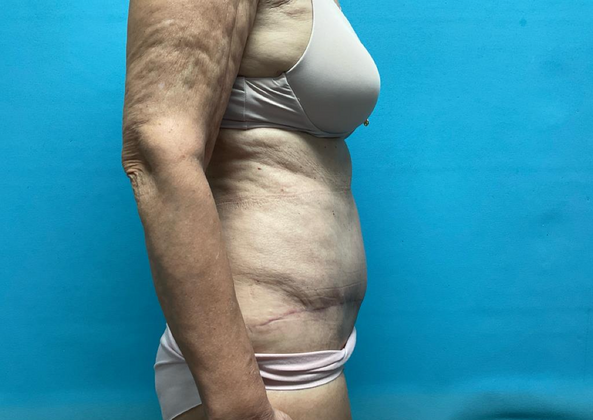 Mommy Makeover: Case 14 - After