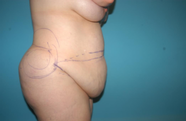 Mommy Makeover: Case 15 - Before