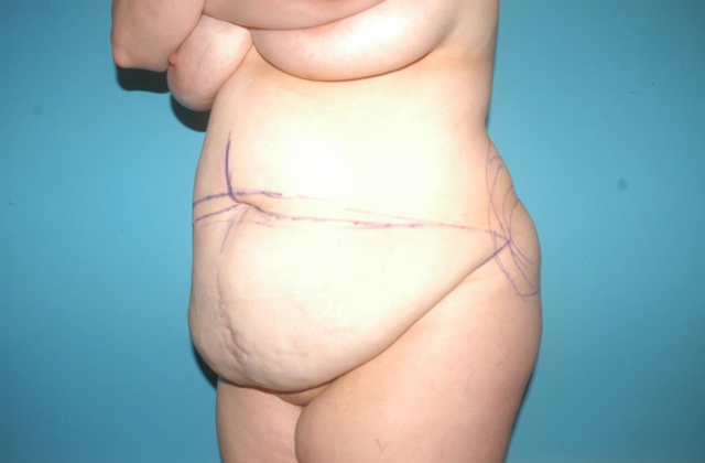 Mommy Makeover: Case 15 - Before