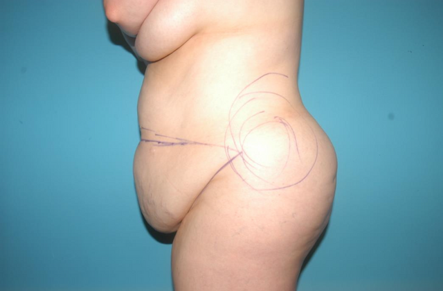 Mommy Makeover: Case 15 - Before