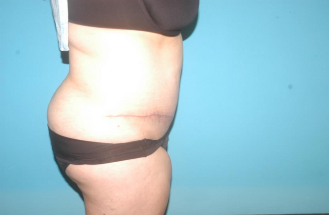 Mommy Makeover: Case 15 - After