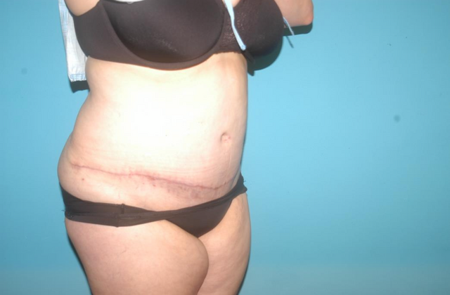 Mommy Makeover: Case 15 - After