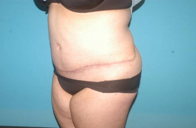 Mommy Makeover: Case 15 - After