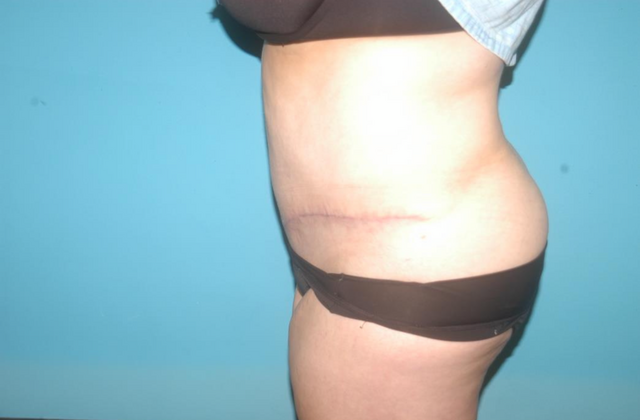 Mommy Makeover: Case 15 - After