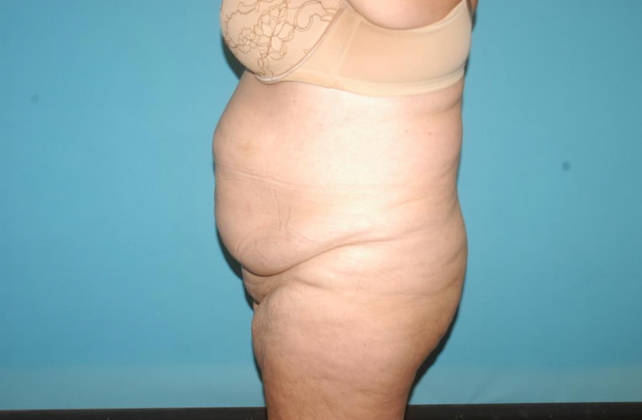 Mommy Makeover: Case 16 - Before