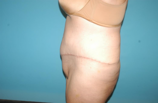 Mommy Makeover: Case 16 - After