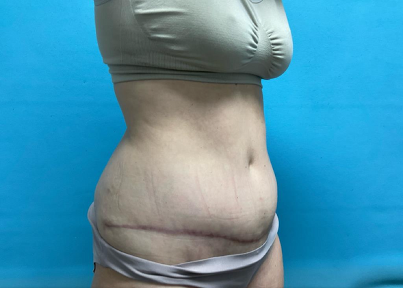 Mommy Makeover: Case 17 - After