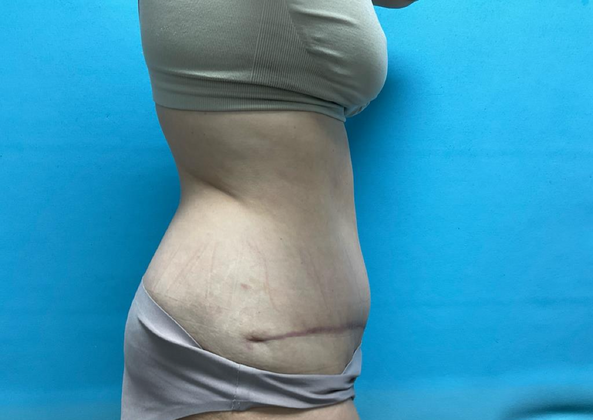 Mommy Makeover: Case 17 - After