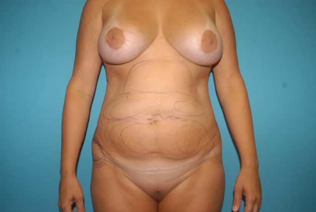 Liposuction Case 5 - Before