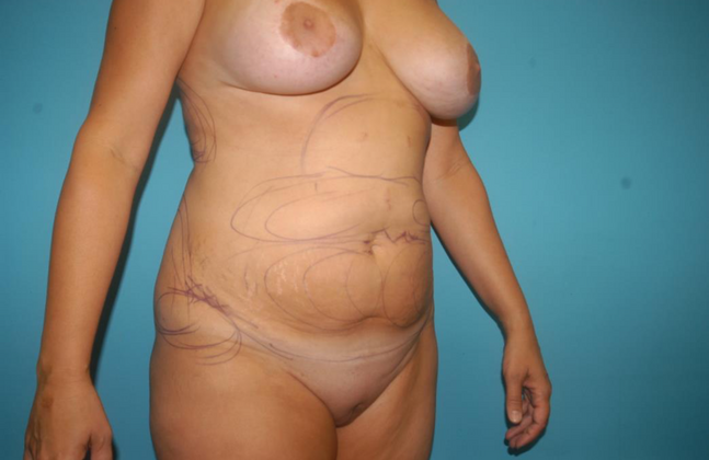 Liposuction: Case 5 - Before