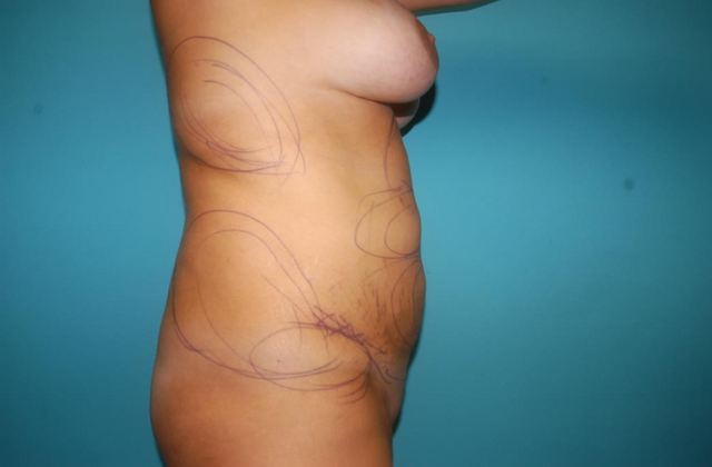 Liposuction: Case 5 - Before