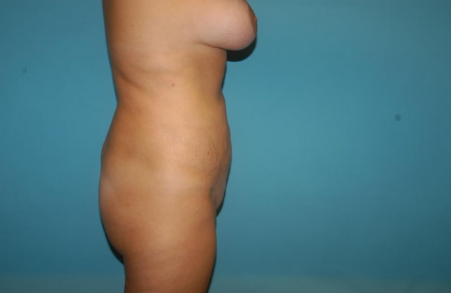 Liposuction: Case 5 - After