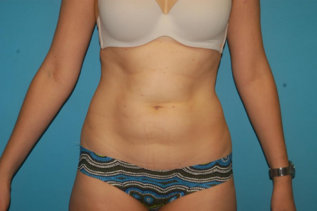 Liposuction Case 7 - Before