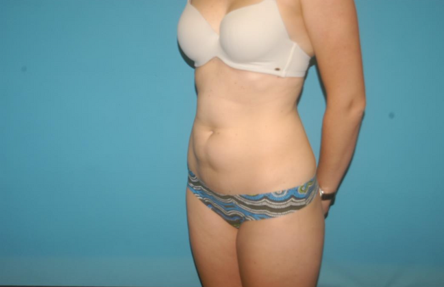 Liposuction: Case 7 - Before