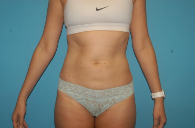 Liposuction Case 7 - After