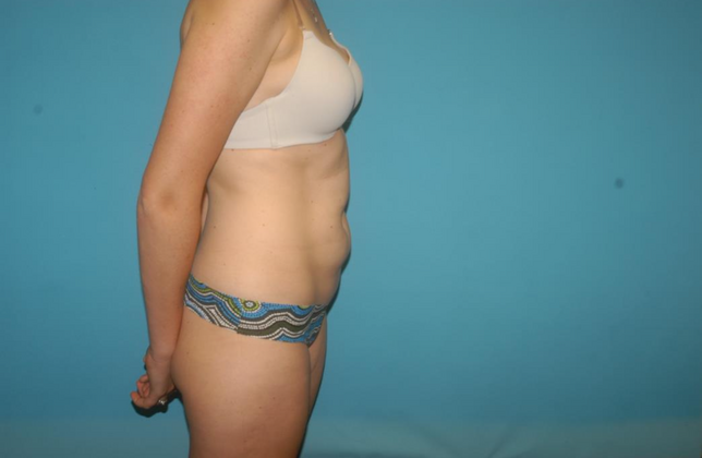 Liposuction: Case 7 - Before