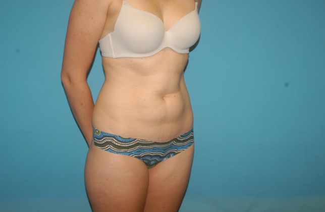 Liposuction: Case 7 - Before