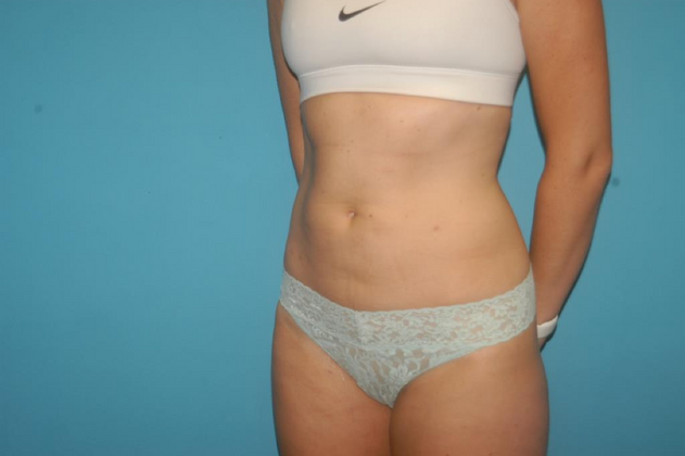 Liposuction: Case 7 - After