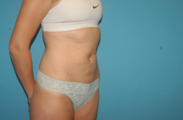 Liposuction: Case 7 - After