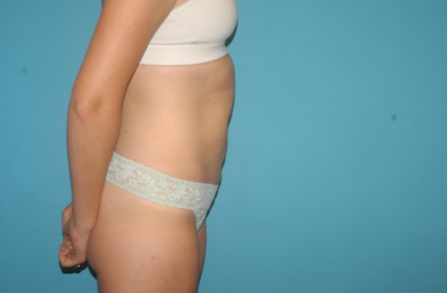 Liposuction: Case 7 - After