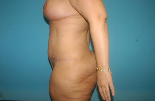 Mommy Makeover: Case 18 - After