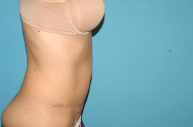 Mommy Makeover: Case 19 - Before