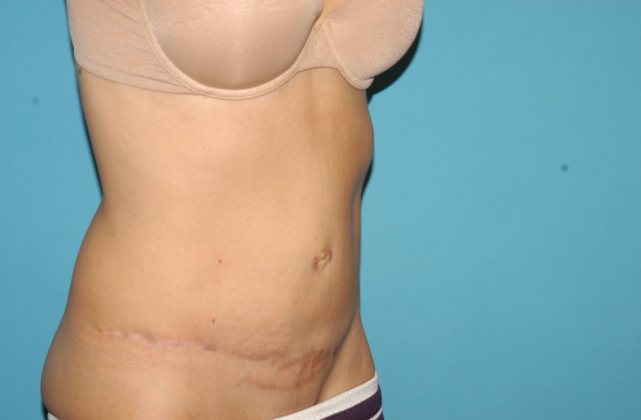 Mommy Makeover: Case 19 - Before