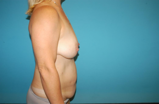 Mommy Makeover: Case 20 - Before