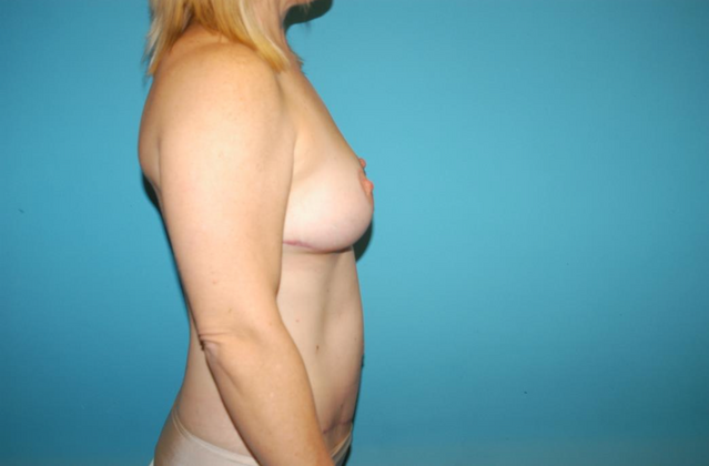 Mommy Makeover: Case 20 - After