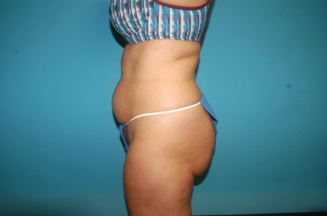 Mommy Makeover: Case 21 - Before