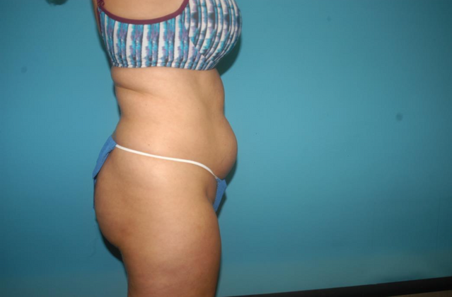 Mommy Makeover: Case 21 - Before