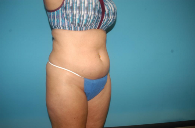 Mommy Makeover: Case 21 - Before