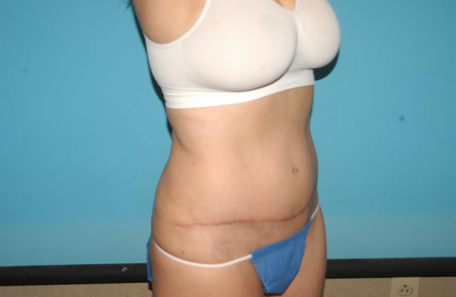 Mommy Makeover: Case 21 - After