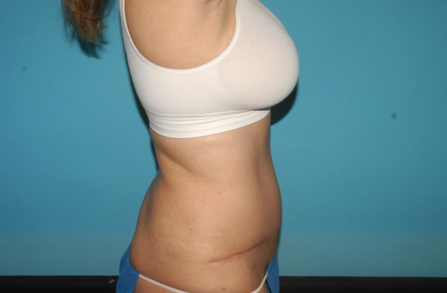 Mommy Makeover: Case 21 - After