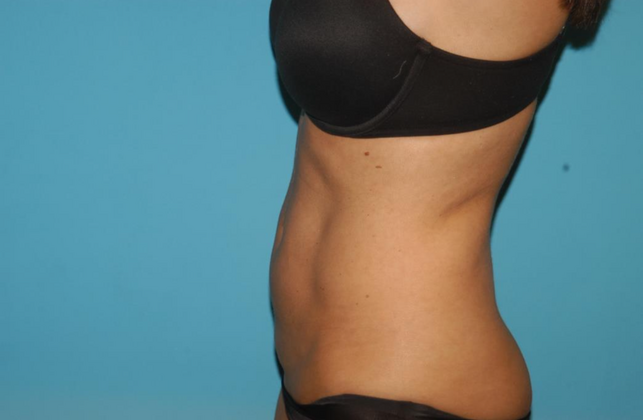Liposuction: Case 8 - Before