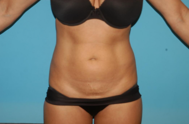 Liposuction Case 8 - Before
