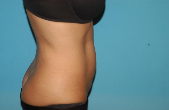 Liposuction: Case 8 - Before