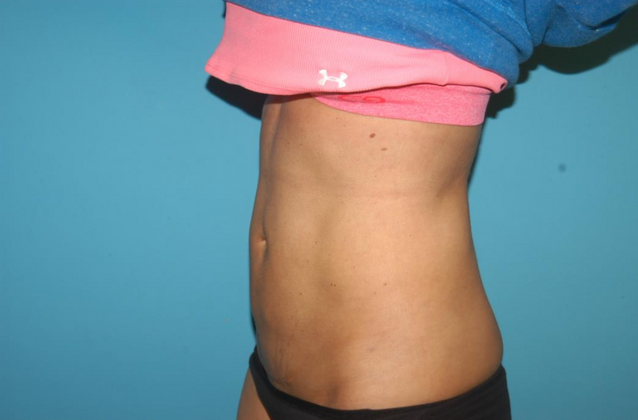 Liposuction: Case 8 - After