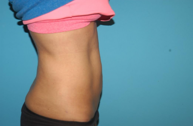 Liposuction: Case 8 - After