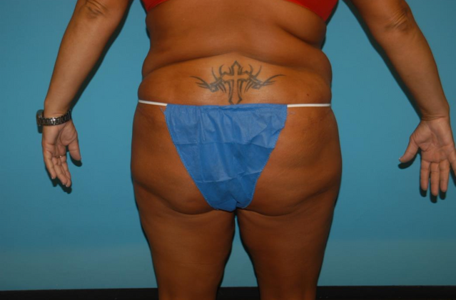 Mommy Makeover: Case 22 - Before