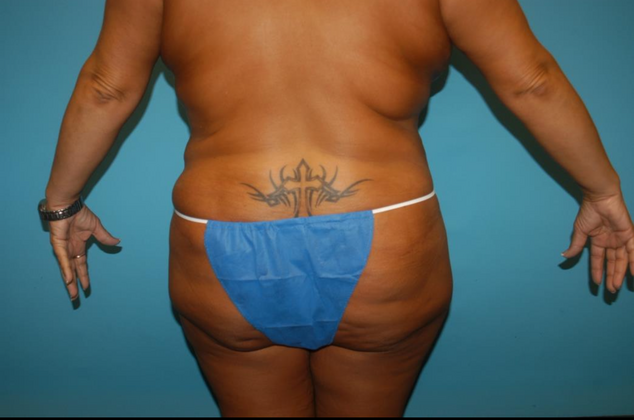 Mommy Makeover: Case 22 - After