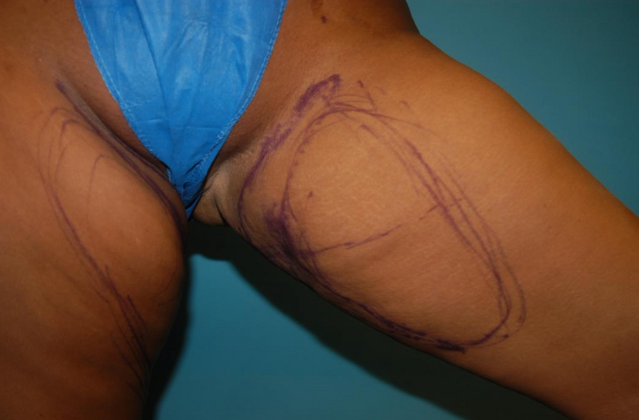 Mommy Makeover: Case 22 - Before