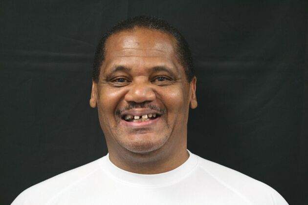 Implant supported Fixed Hybrid Overdenture Case 2 - Before