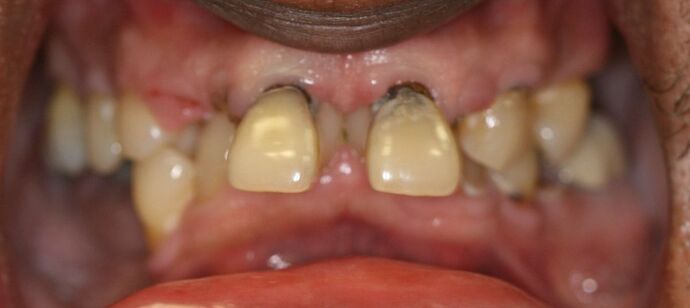 Implant supported Fixed Hybrid Overdenture: Case 2 - Before