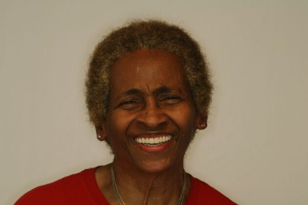 Implant supported Fixed Hybrid Overdenture: Case 1 - After